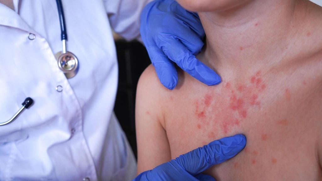 Minnesota's 80 measles cases this year are the most since 1990, health officials say — Eagan Health news